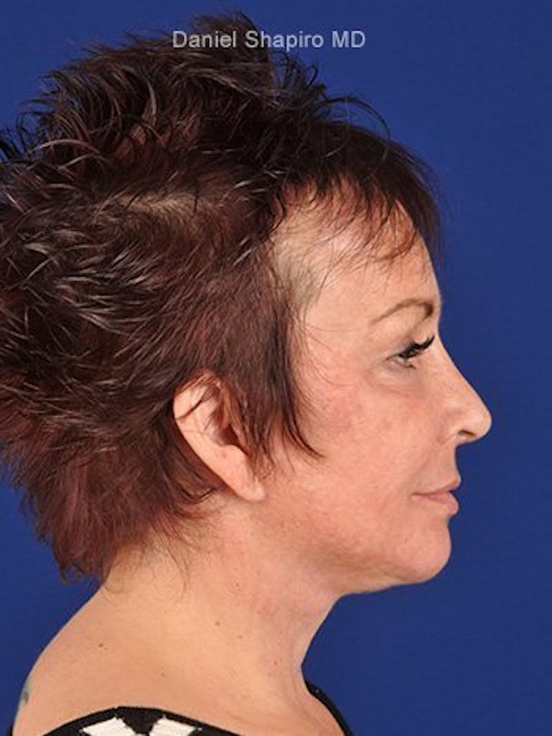 Facelift Before & After Gallery - Patient 10974305 - Image 6