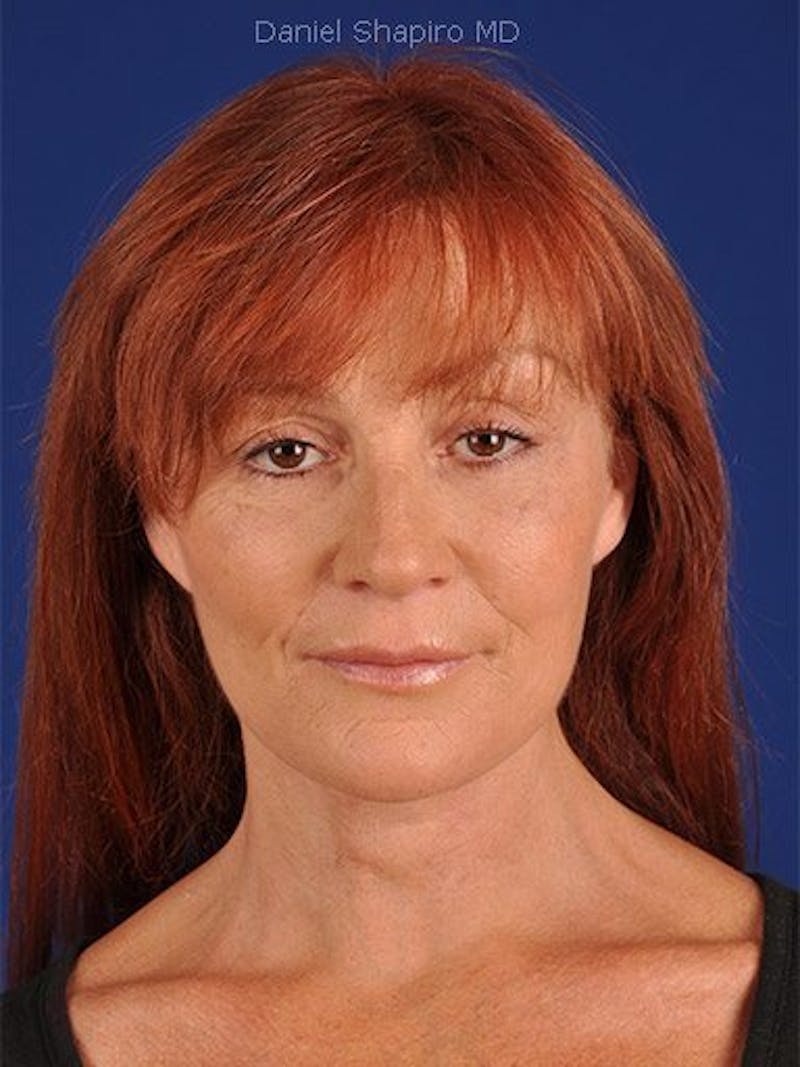 Facelift Before & After Gallery - Patient 10974306 - Image 2