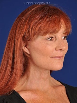 Facelift Before & After Gallery - Patient 10974306 - Image 4