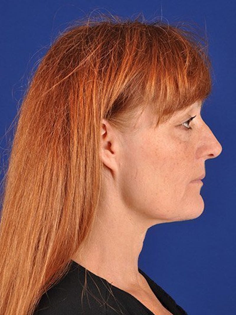 Facelift Before & After Gallery - Patient 10974306 - Image 5