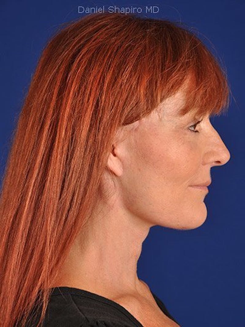 Facelift Before & After Gallery - Patient 10974306 - Image 6