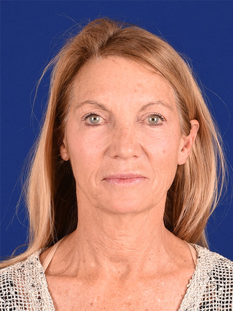 Facelift Before & After Gallery - Patient 10974307 - Image 1