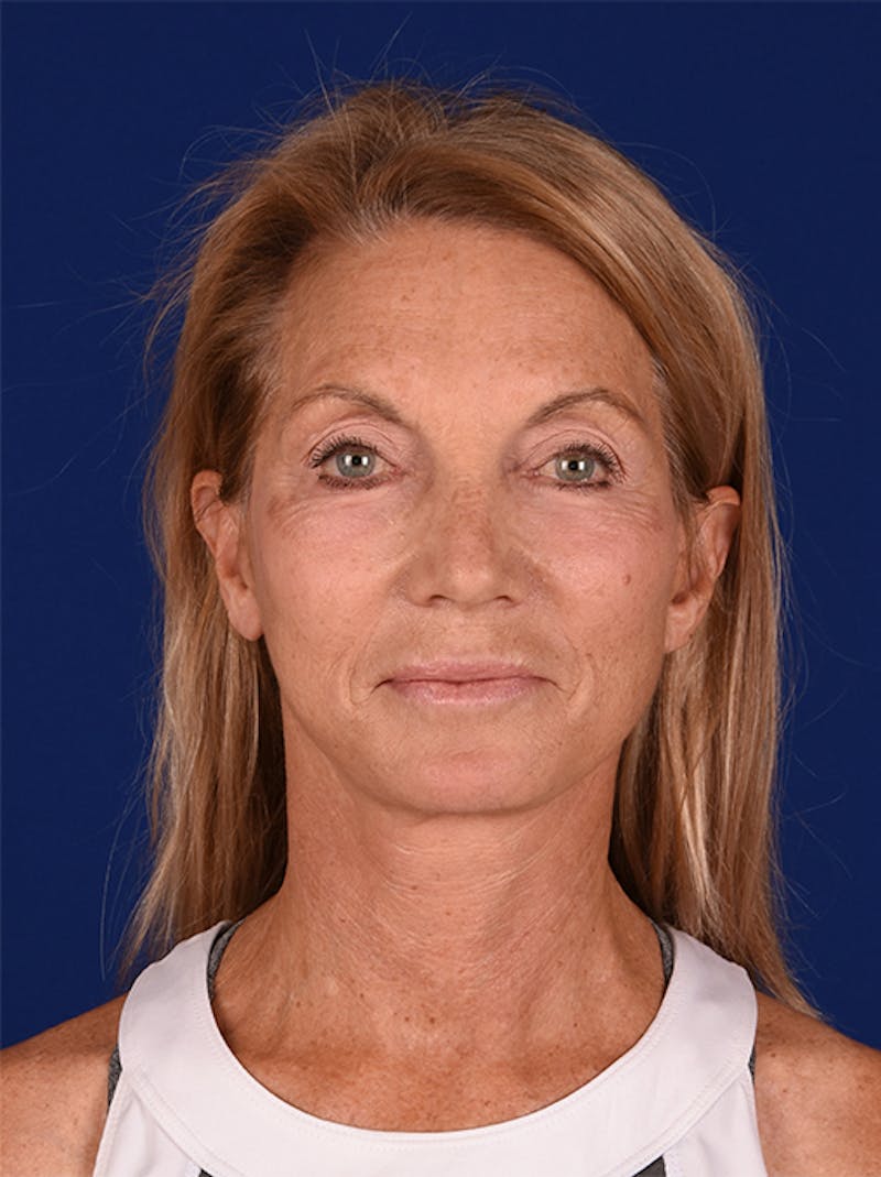 Facelift Before & After Gallery - Patient 10974307 - Image 2