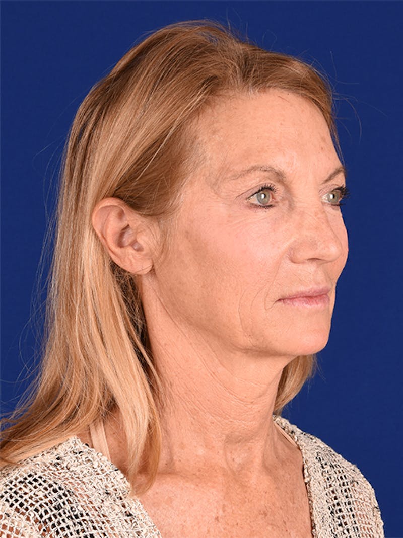 Facelift Before & After Gallery - Patient 10974307 - Image 3