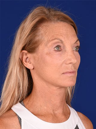 Facelift Before & After Gallery - Patient 10974307 - Image 4