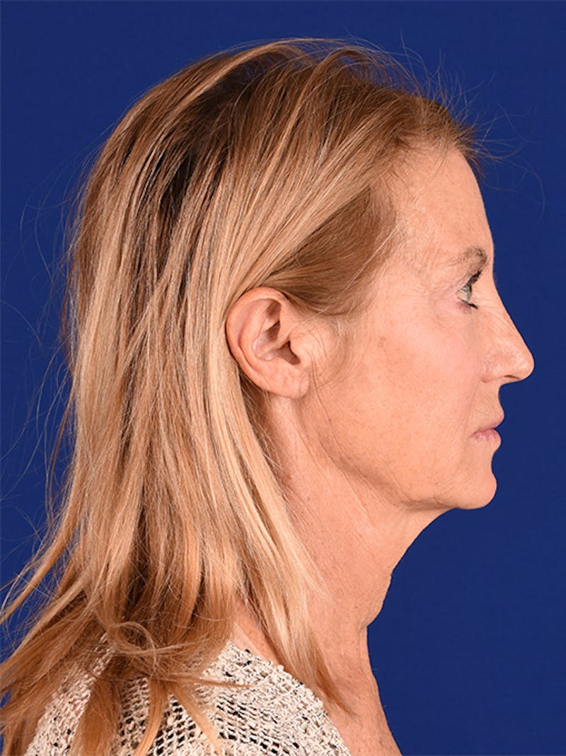 Facelift Before & After Gallery - Patient 10974307 - Image 5