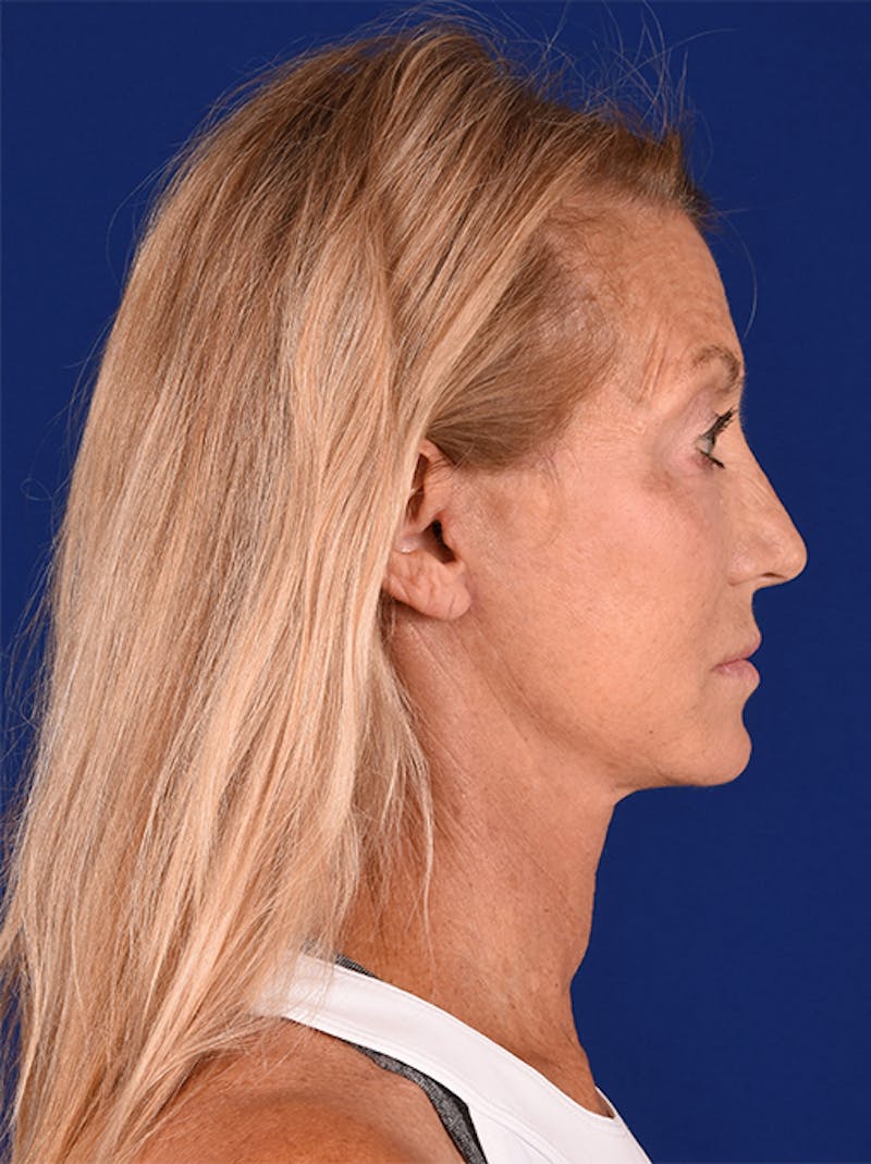 Facelift Before & After Gallery - Patient 10974307 - Image 6