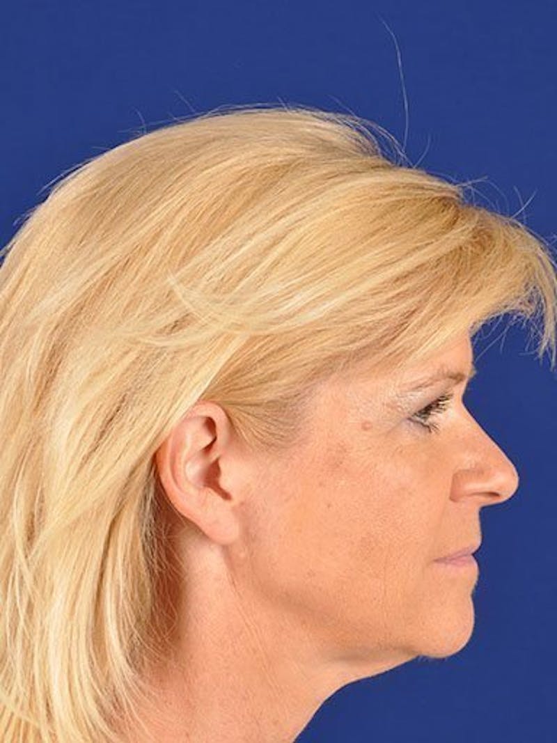 Facelift Before & After Gallery - Patient 10974309 - Image 3