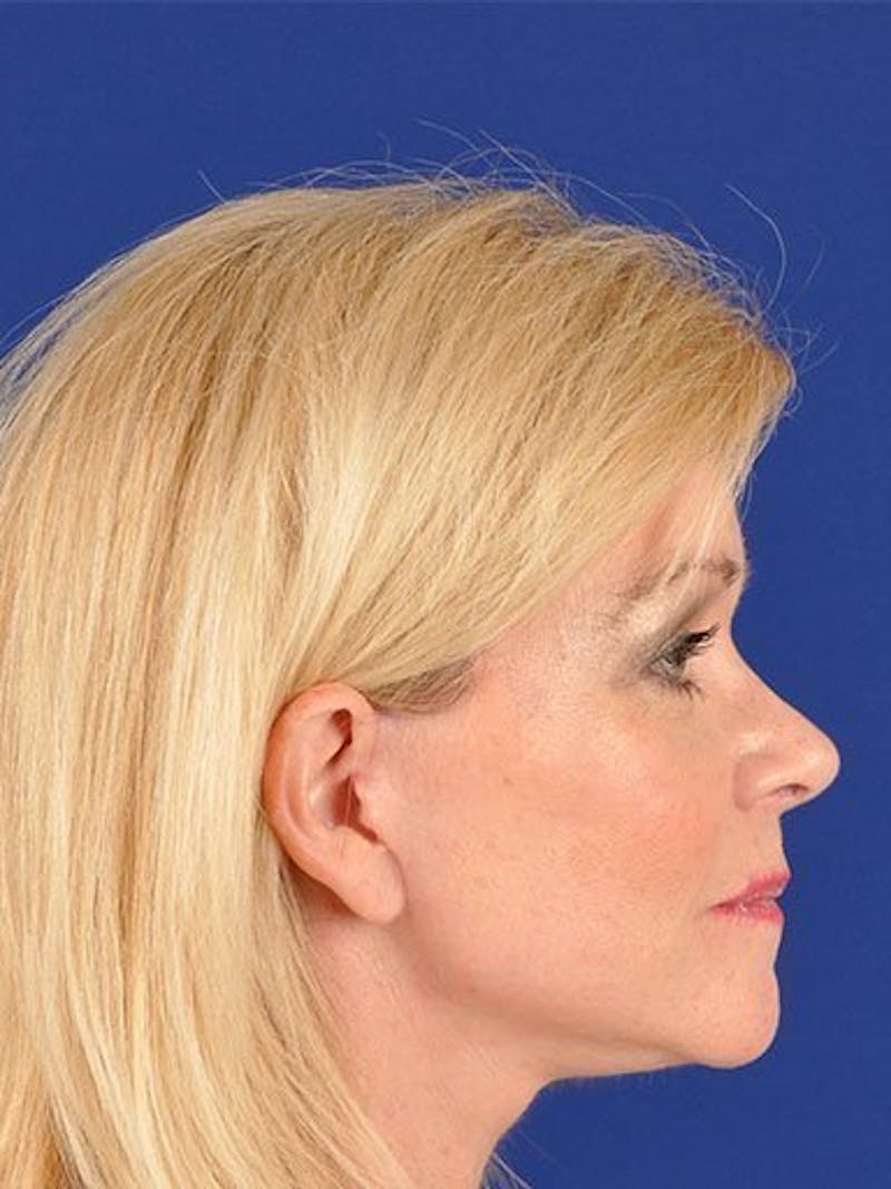 Facelift Before & After Gallery - Patient 10974309 - Image 4