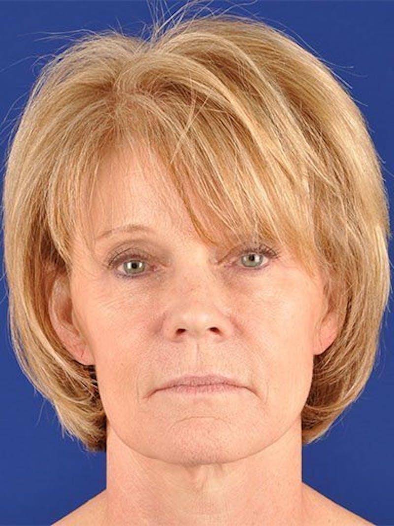 Facelift Before & After Gallery - Patient 10974310 - Image 1