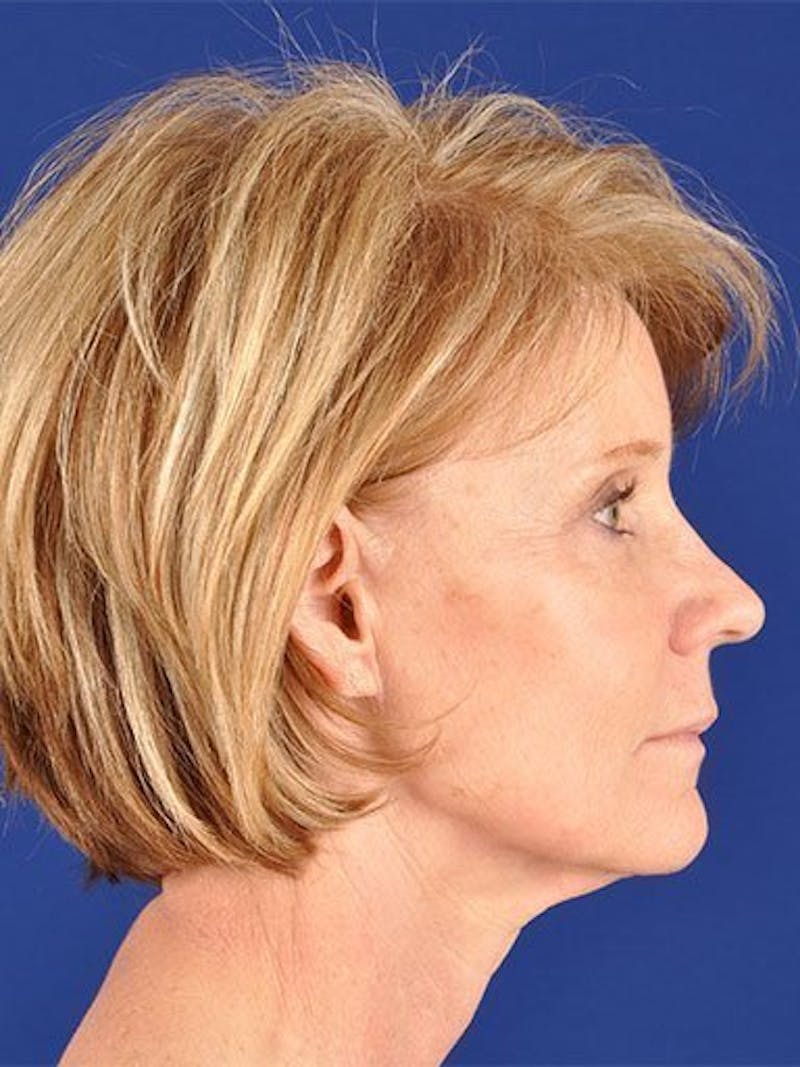 Facelift Before & After Gallery - Patient 10974310 - Image 3