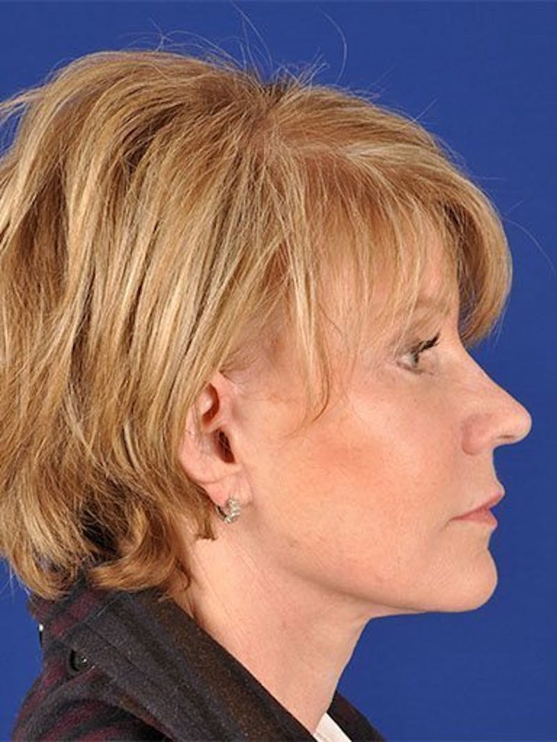 Facelift Before & After Gallery - Patient 10974310 - Image 4