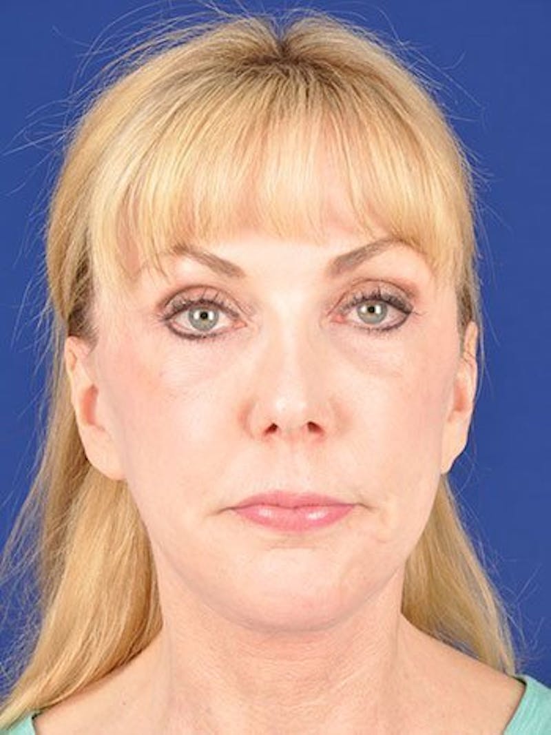 Facelift Before & After Gallery - Patient 10974313 - Image 2