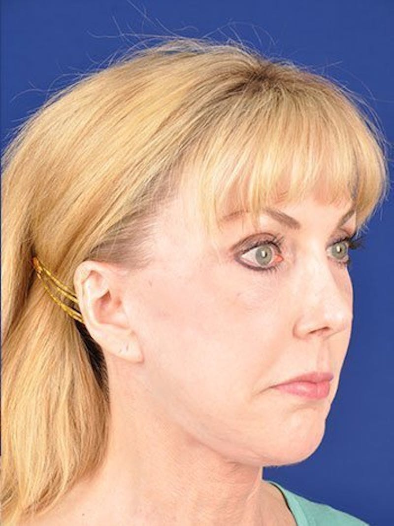Facelift Before & After Gallery - Patient 10974313 - Image 3