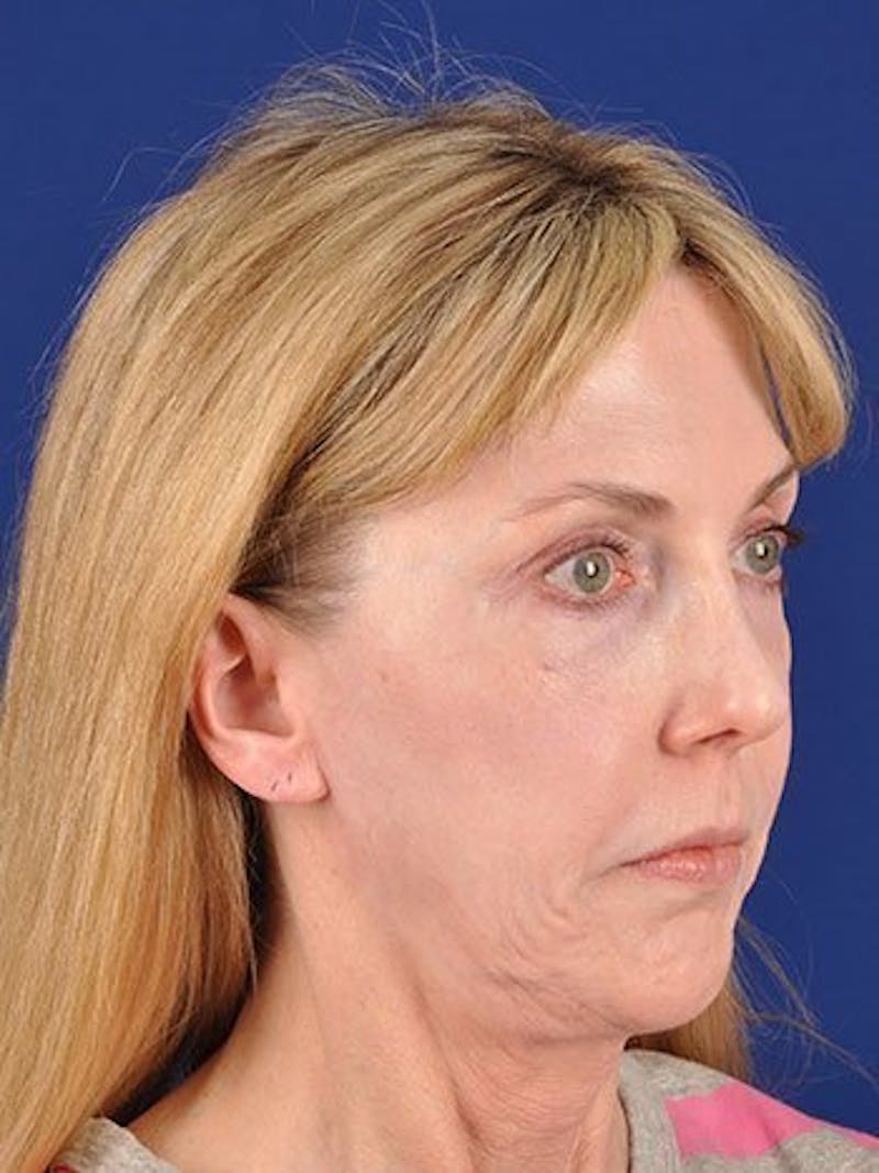 Facelift Before & After Gallery - Patient 10974313 - Image 4