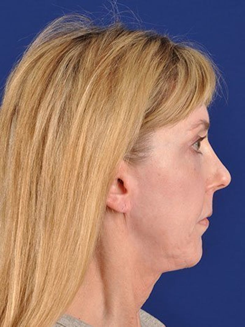 Facelift Before & After Gallery - Patient 10974313 - Image 5
