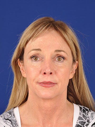 Facelift Before & After Gallery - Patient 10974315 - Image 1