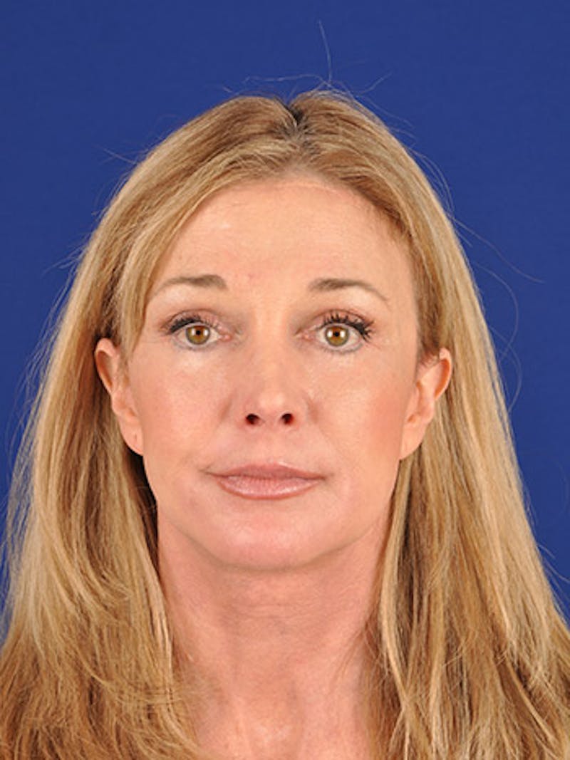 Facelift Before & After Gallery - Patient 10974315 - Image 2