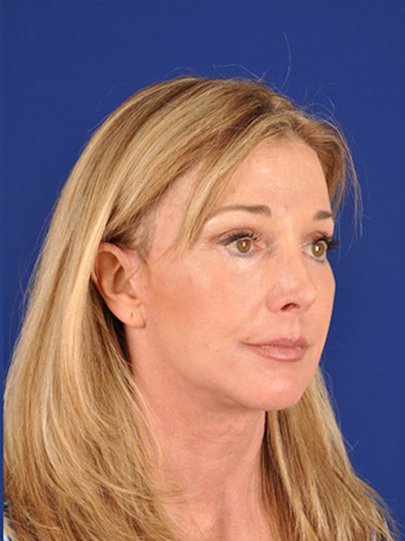 Facelift Before & After Gallery - Patient 10974315 - Image 4