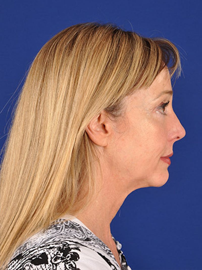 Facelift Before & After Gallery - Patient 10974315 - Image 5