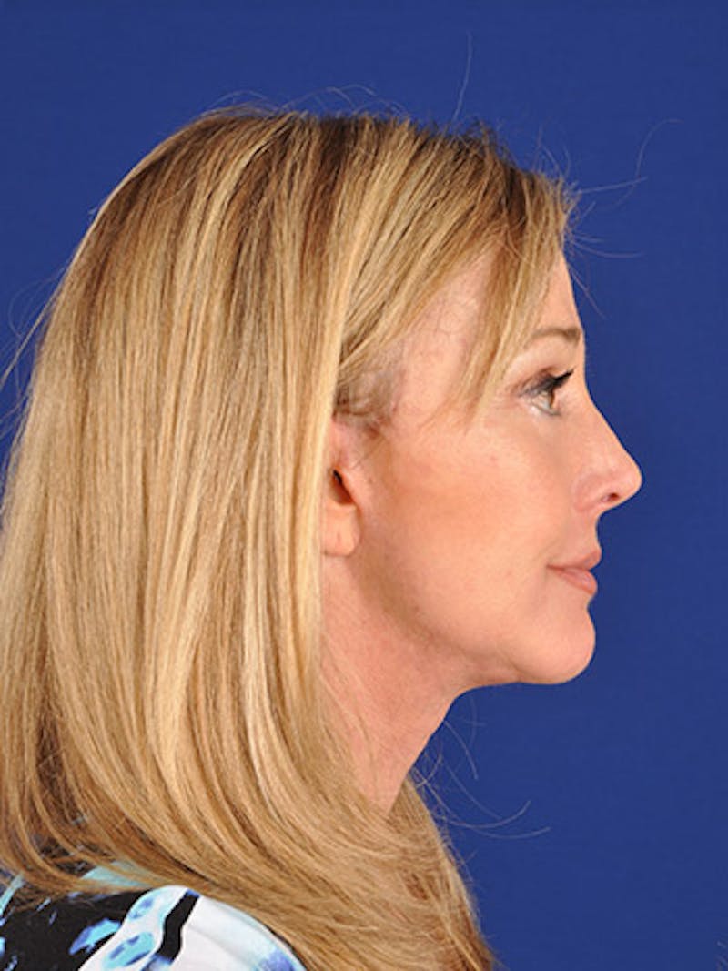 Facelift Before & After Gallery - Patient 10974315 - Image 6