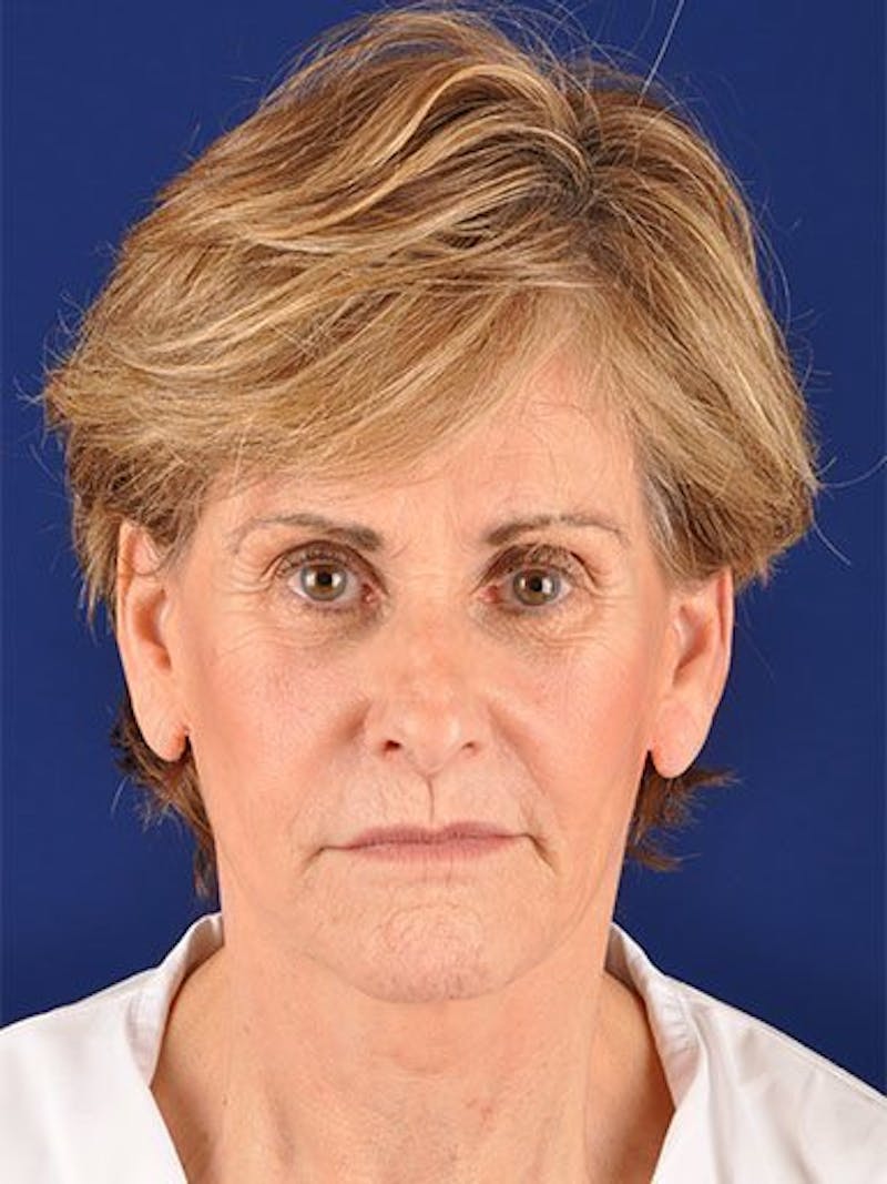 Facelift Before & After Gallery - Patient 10974316 - Image 1