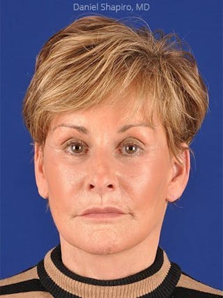 Facelift Before & After Gallery - Patient 10974316 - Image 2