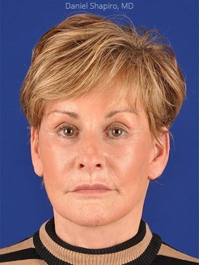 Facelift Before & After Gallery - Patient 10974316 - Image 2