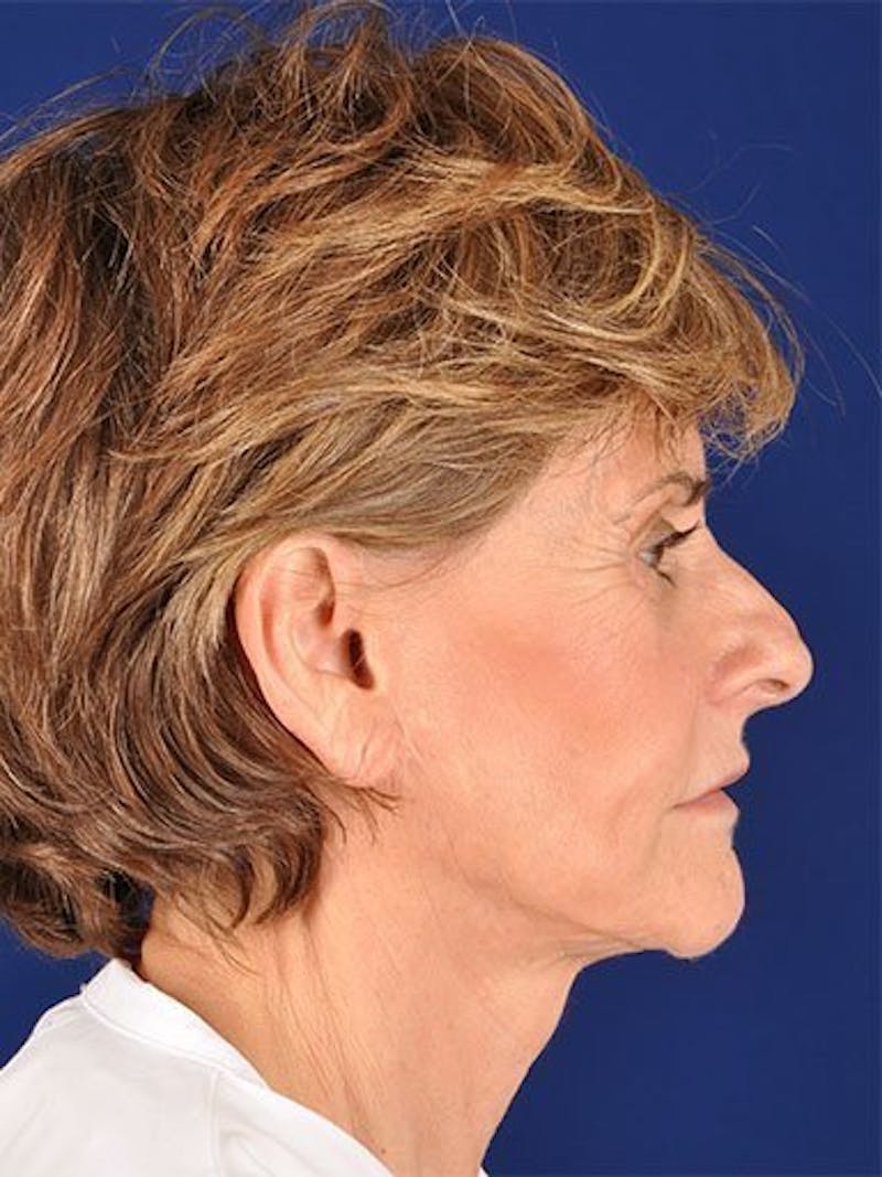 Facelift Before & After Gallery - Patient 10974316 - Image 3