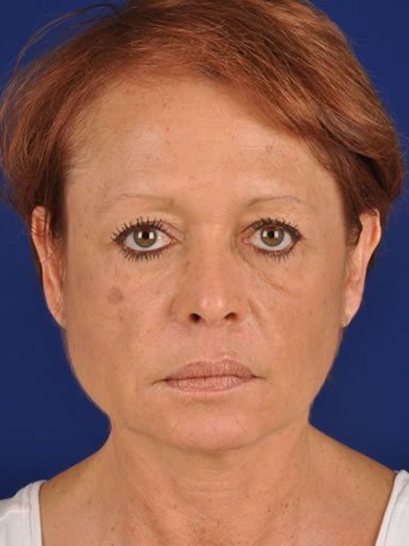 Facelift Before & After Gallery - Patient 10974317 - Image 1