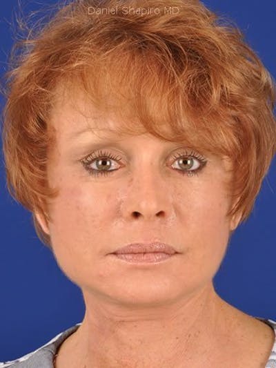 Facelift Before & After Gallery - Patient 10974317 - Image 2