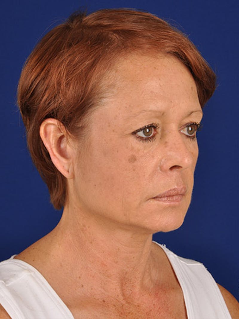 Facelift Before & After Gallery - Patient 10974317 - Image 3