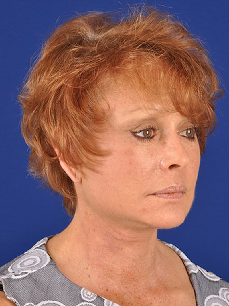 Facelift Before & After Gallery - Patient 10974317 - Image 4