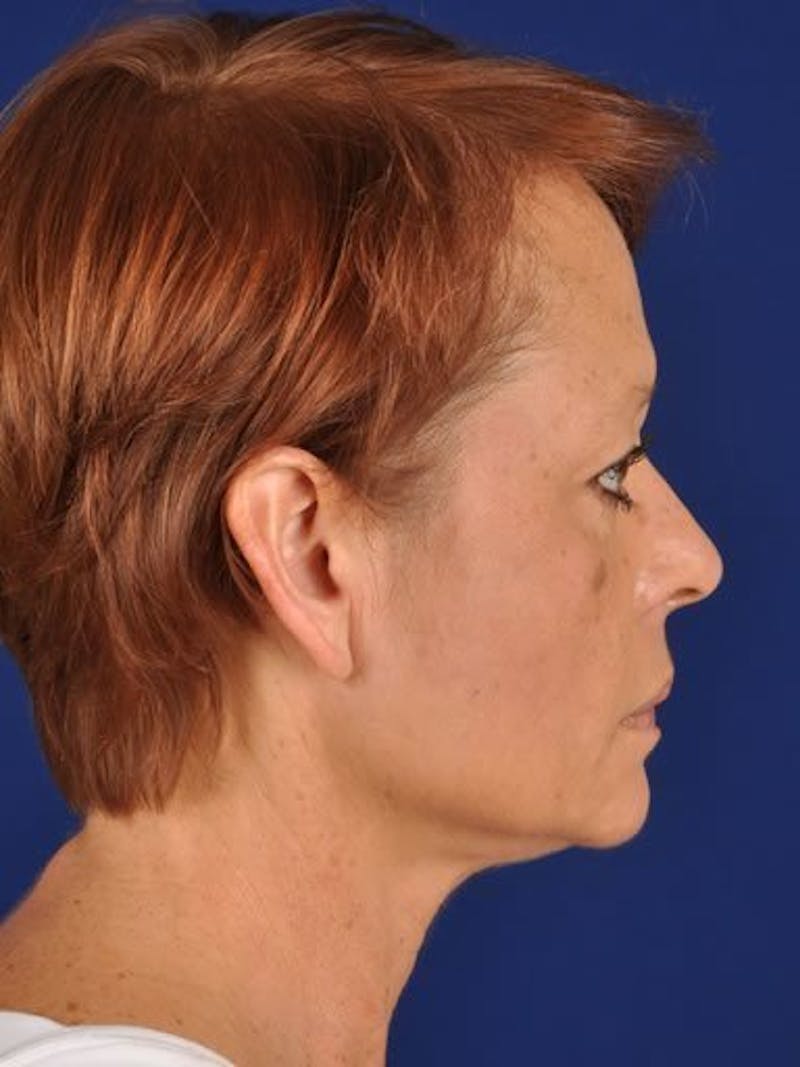 Facelift Before & After Gallery - Patient 10974317 - Image 5