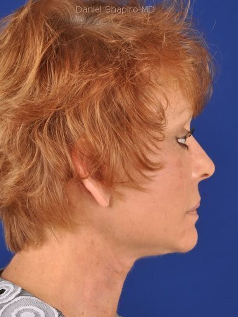 Facelift Before & After Gallery - Patient 10974317 - Image 6