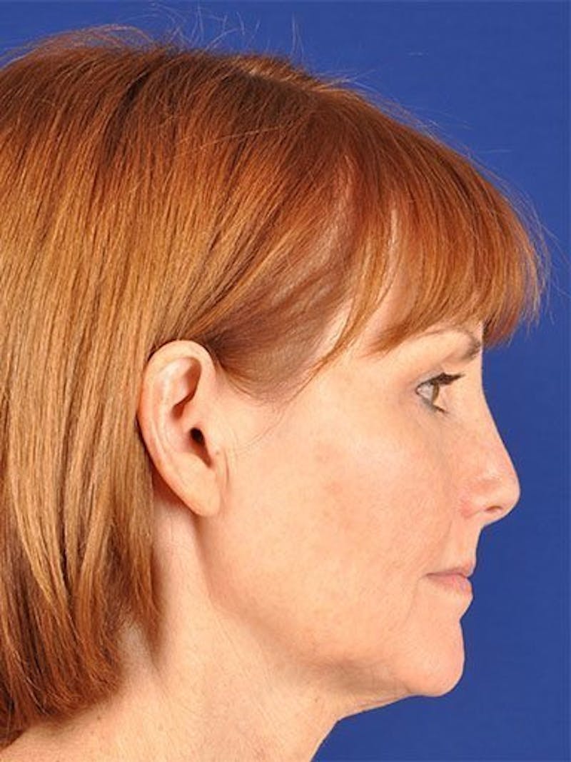 Facelift Before & After Gallery - Patient 10974319 - Image 5