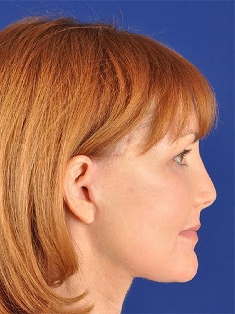 Facelift Before & After Gallery - Patient 10974319 - Image 6