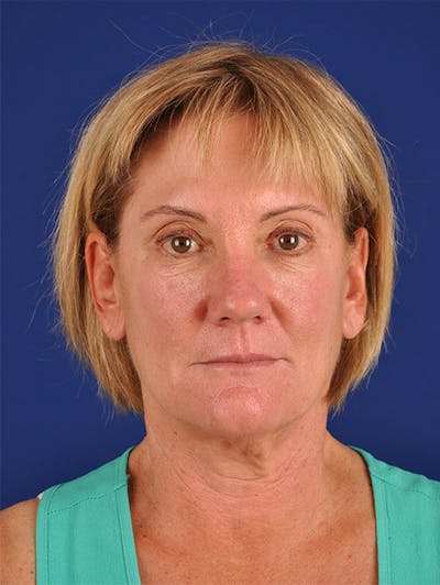 Facelift Before & After Gallery - Patient 10974320 - Image 1