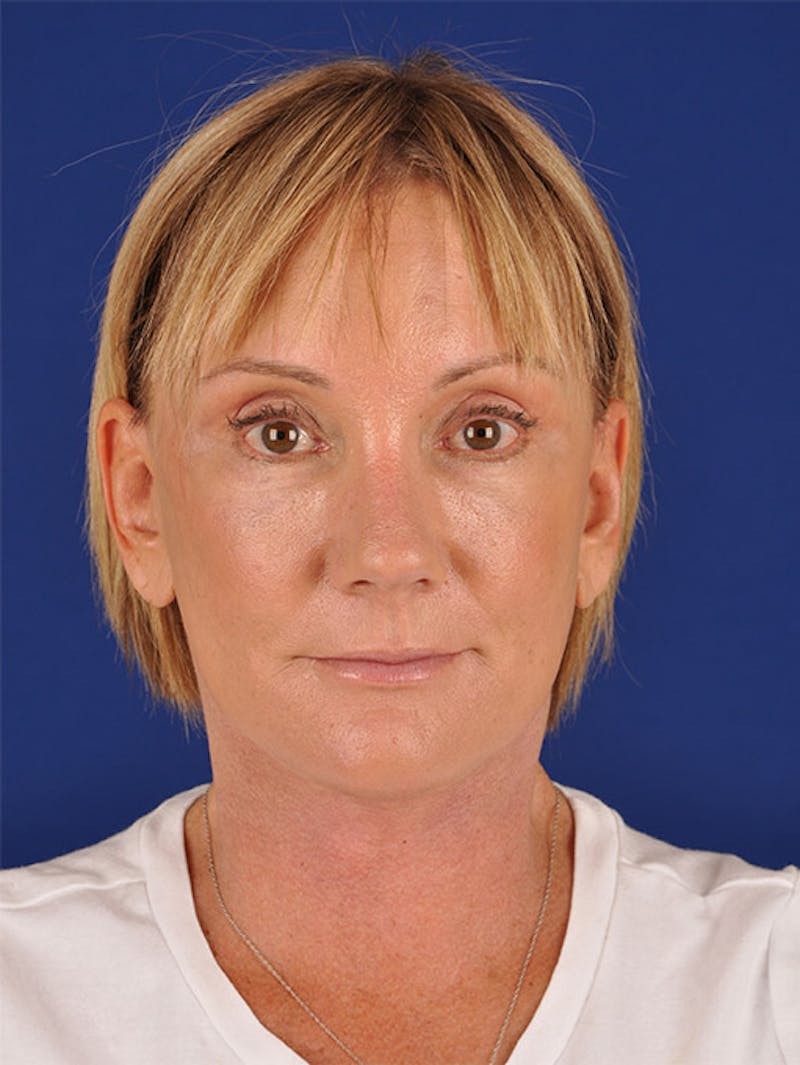 Facelift Before & After Gallery - Patient 10974320 - Image 2