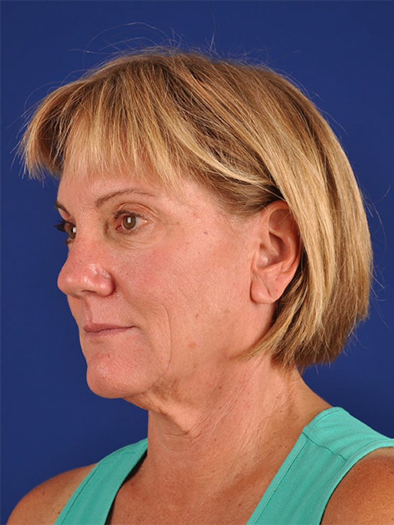 Facelift Before & After Gallery - Patient 10974320 - Image 3