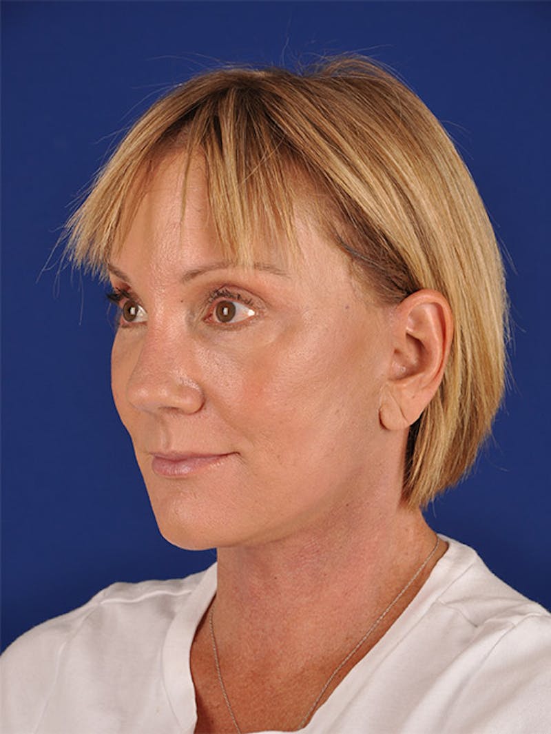 Facelift Before & After Gallery - Patient 10974320 - Image 4