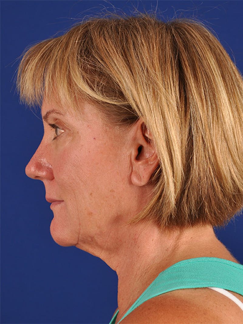 Facelift Before & After Gallery - Patient 10974320 - Image 5