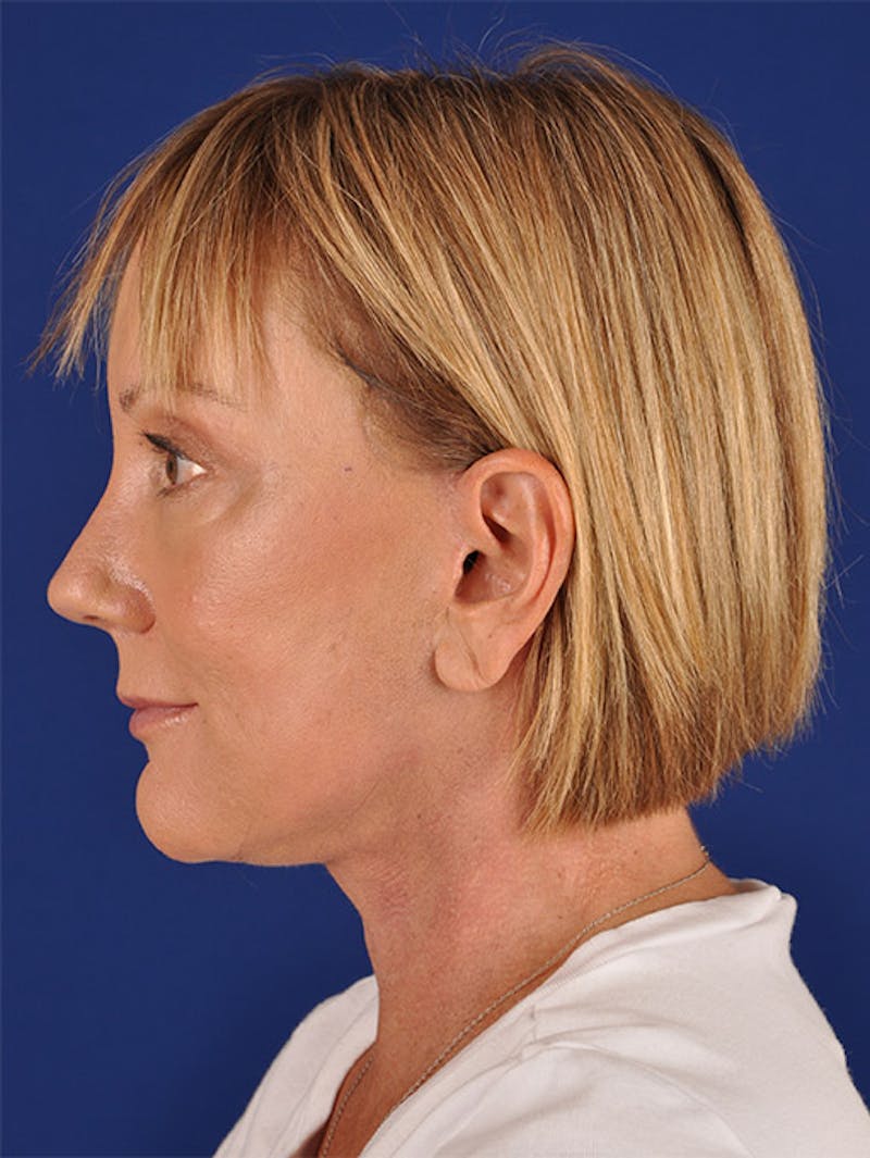 Facelift Before & After Gallery - Patient 10974320 - Image 6