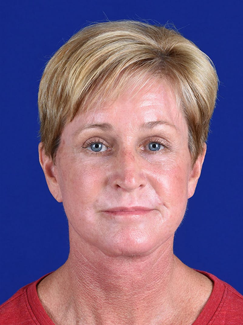 Facelift Before & After Gallery - Patient 10974323 - Image 2
