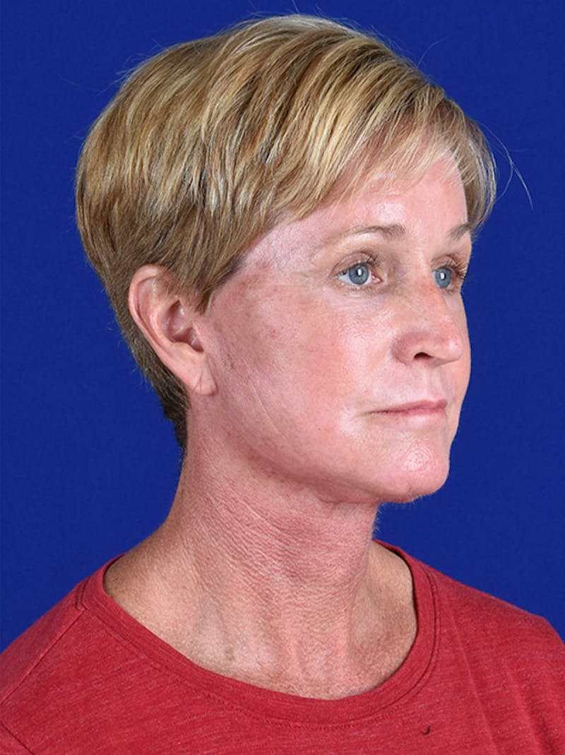 Facelift Before & After Gallery - Patient 10974323 - Image 4