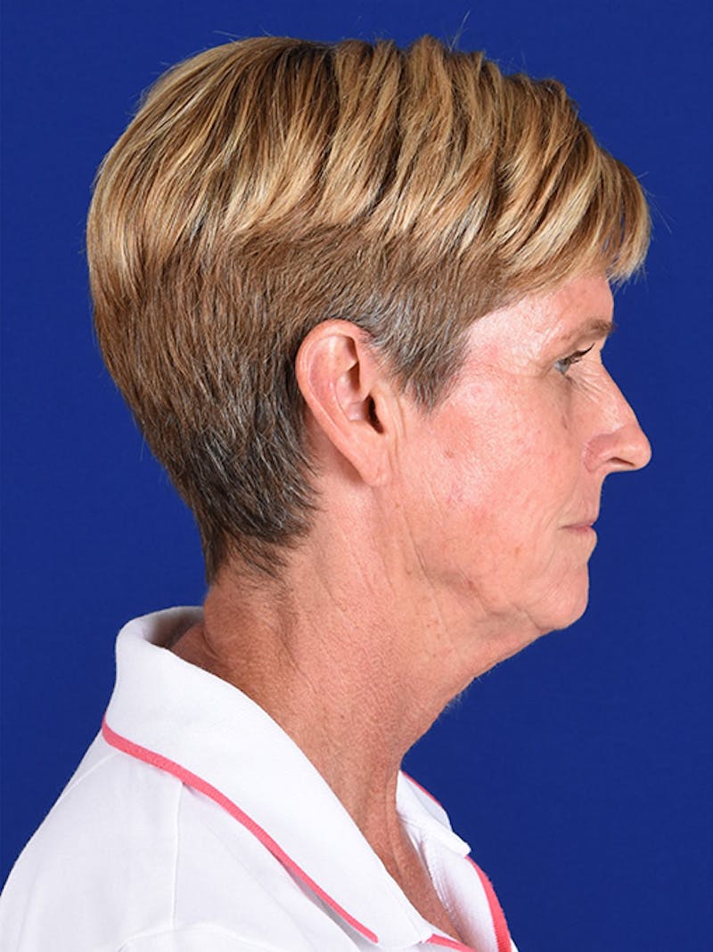 Facelift Before & After Gallery - Patient 10974323 - Image 5