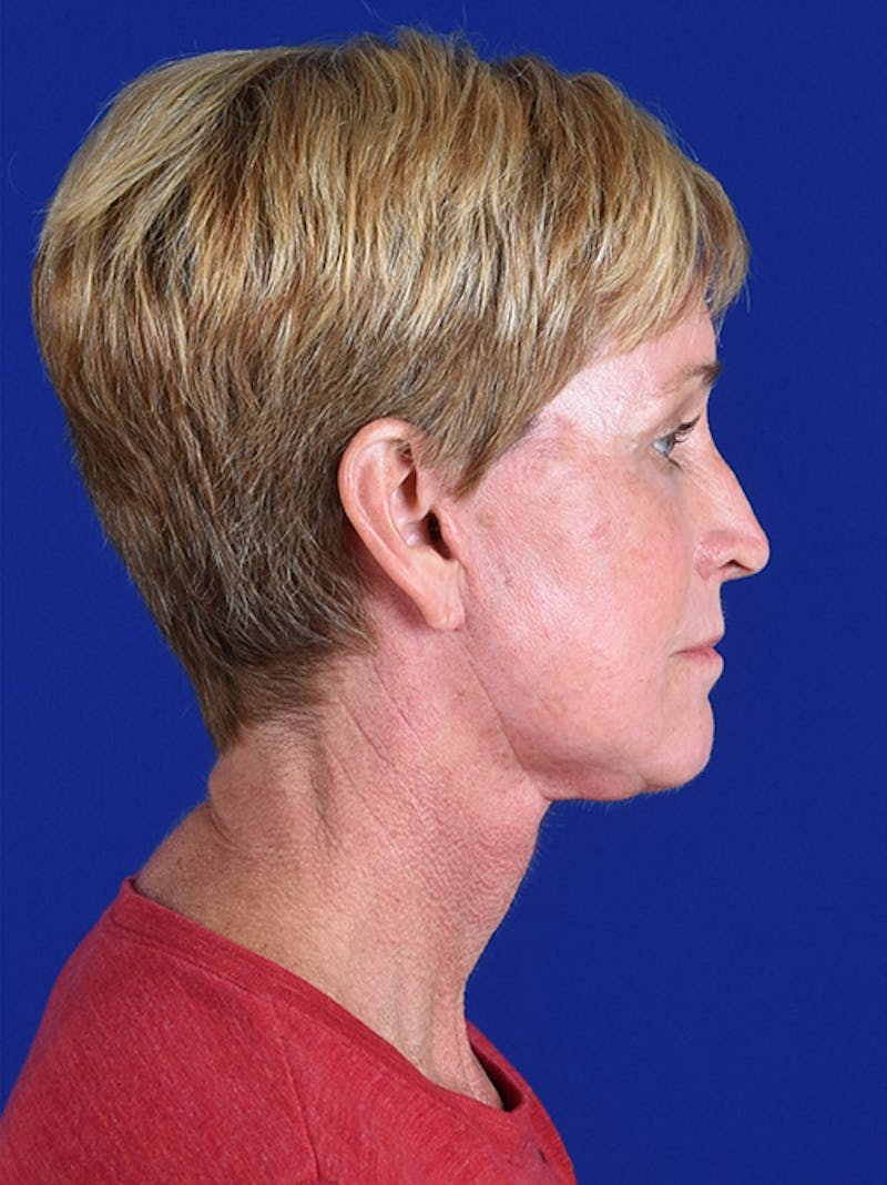 Facelift Before & After Gallery - Patient 10974323 - Image 6
