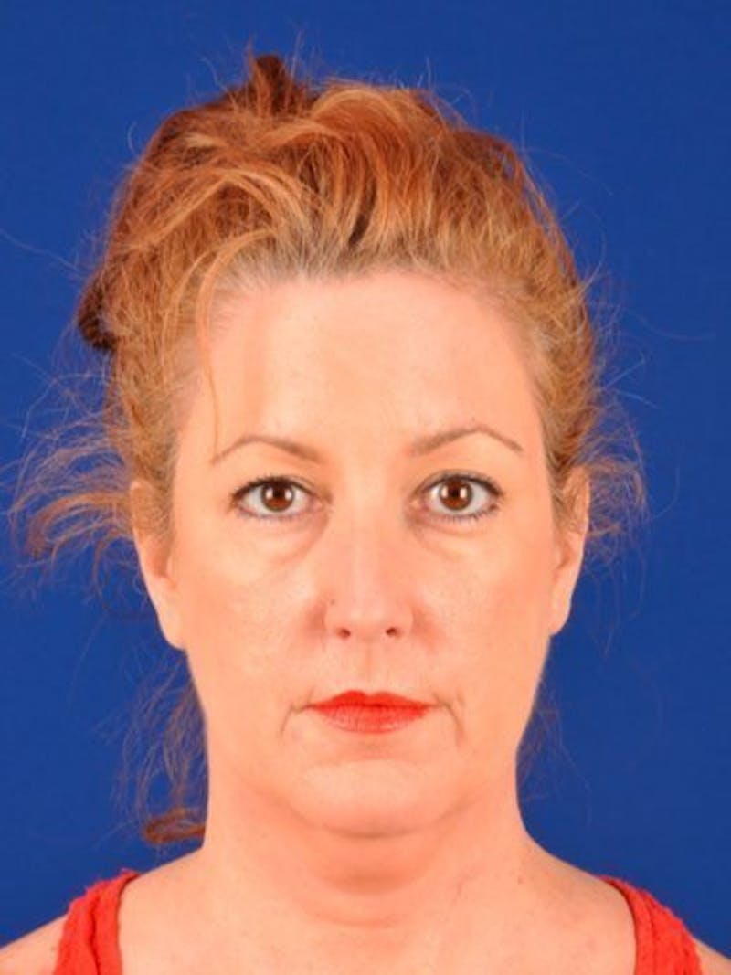 Facelift Before & After Gallery - Patient 10974324 - Image 1