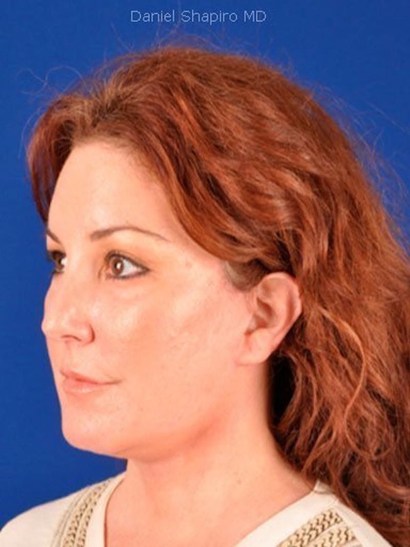 Facelift Before & After Gallery - Patient 10974324 - Image 4