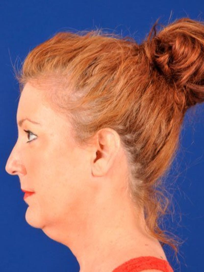 Facelift Before & After Gallery - Patient 10974324 - Image 5